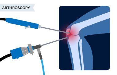 Arthroscopy medical procedure. Knee joint minimally invasive surgery. Arthroscope and arthroscopic instrument. Patella replacement, leg injury, kneecap reconstruction. Ligament and meniscus vector. clipart
