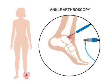 Ayak bileği artroskopisi prosedürü. Ayak eklemi minimum invaziv cerrahi konsepti. Artroskop ve artroskopik alet. Ayak tedavisi, bacak ağrısı ve iltihap. Anatomik x ışını vektör çizimi