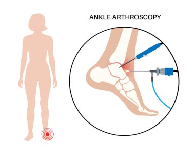 Ankle arthroscopy procedure. Feet joint minimally invasive surgery concept. Arthroscope and arthroscopic instrument. Foot treatment, leg pain and inflammation. Anatomical x ray vector illustration clipart