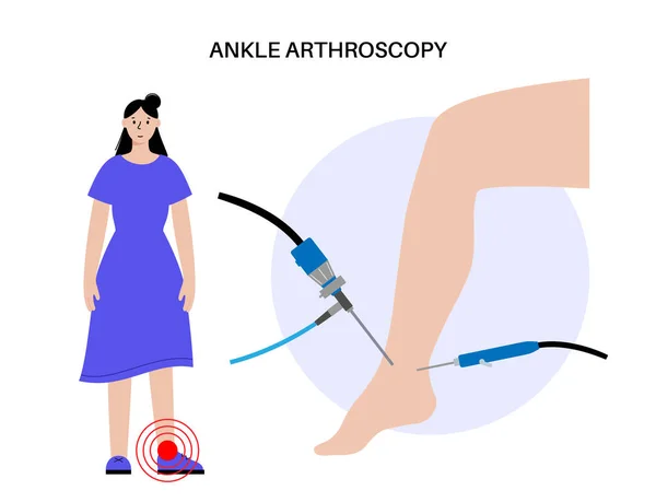 Ayak Bileği Artroskopisi Prosedürü Ayak Eklemi Minimum Invaziv Cerrahi Konsepti — Stok Vektör