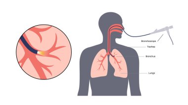 Bronkoskopi prosedürü. Pulmonolog ağızdan akciğere doğru bronkoskop kullanıyor. Solunum sistemi hastalıkları ve tedavisi. Endobronşiyal ultrason bronkoskopi tanısal vektör çizimi.