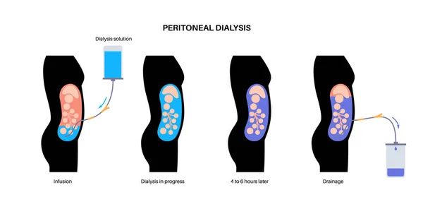 stock vector Peritoneal dialysis procedure. Fluid in peritoneal cavity. Peritoneum in the abdomen, substances are exchanged with blood. Soft tube in human body, catheter concept. Remove excess fluid from belly