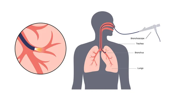 気管支鏡検査手順 肺腫瘍学者は肺に口から気管支鏡を使用しています 呼吸器系疾患や治療 内視鏡超音波気管支鏡検査ベクトル図 — ストックベクタ