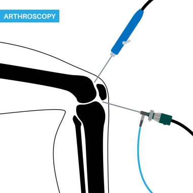 Artroskopi tıbbi prosedürü. Diz eklemi minimal invaziv ameliyat. Artroskop ve artroskopik alet. Dizkapağı değişimi, bacak yaralanması, diz kapağı rekonstrüksiyonu. Bağ ve menisküs vektörü.