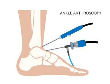 Ayak bileği artroskopisi prosedürü. Ayak eklemi minimum invaziv cerrahi konsepti. Artroskop ve artroskopik alet. Ayak tedavisi, bacak ağrısı ve iltihap. Anatomik x ışını vektör çizimi