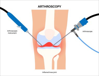 Arthroscopy medical procedure. Knee joint minimally invasive surgery. Arthroscope and arthroscopic instrument. Patella treatment, leg pain, kneecap inflammation. Ligament and meniscus anatomy vector. clipart