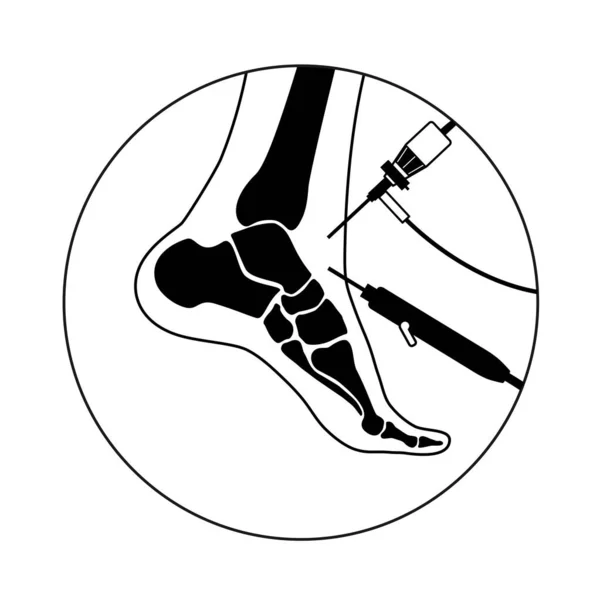 Ankelartroskopi Fötter Gemensamma Minimalt Invasiva Kirurgi Koncept Artroskop Och Artroskopiskt — Stock vektor