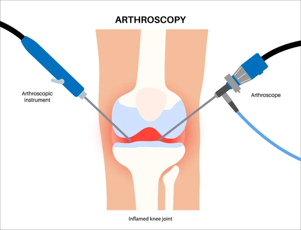 Arthroskopie Medizinischer Eingriff Minimal Invasive Kniegelenkchirurgie Arthroskop Und Arthroskopisches Instrument — Stockvektor