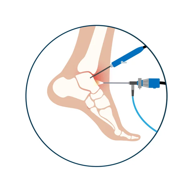 Sprunggelenksarthroskopie Fußgelenk Minimalinvasives Chirurgisches Konzept Arthroskop Und Arthroskopisches Instrument Fußbehandlung — Stockvektor