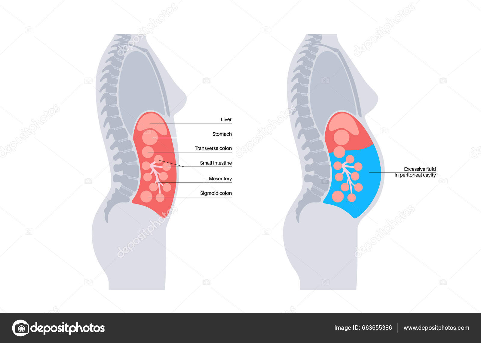 Ascites Anatomy Fluid Peritoneal Cavity Abdominal Distension Pain Ascites Anatomy Fluid Peritoneal Cavity Abdominal Distension Pain