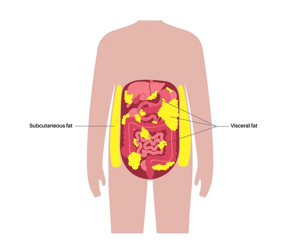 Visceral Fat Medical Poster Belly Fat Surrounds Internal Organs Abdominal — Stock Vector