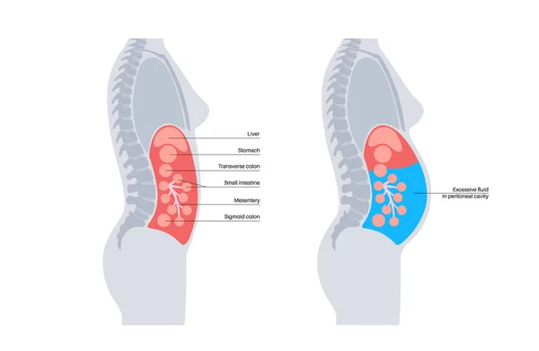 腹水解剖 腹腔内的液体 肿胀和恶心 器官和内脏的压力 肠胃道Gastrointestinal Tract 腹膜腔矢量图解 — 图库矢量图片