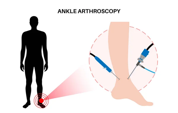 脚踝关节镜检查程序 足部关节微创手术的概念 关节镜和关节镜仪器 脚的治疗 腿的疼痛和发炎 诊所里的人平面病媒图解 — 图库矢量图片