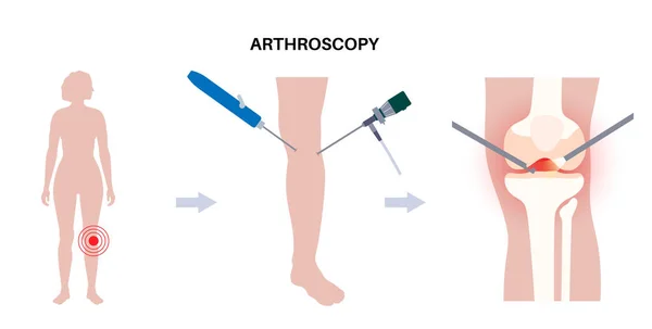 Arthroskopie Medizinischer Eingriff Minimal Invasive Kniegelenkchirurgie Arthroskop Und Arthroskopisches Instrument — Stockvektor