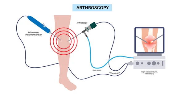 Artroskopi Tıbbi Prosedürü Diz Eklemi Minimal Invaziv Ameliyat Artroskop Artroskopik — Stok Vektör