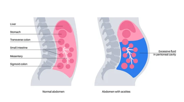 Anatomía Ascitis Fluido Cavidad Peritoneal Distensión Abdominal Dolor Hinchazón Náuseas — Archivo Imágenes Vectoriales