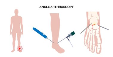 Ayak bileği artroskopisi prosedürü. Ayak eklemi minimum invaziv cerrahi konsepti. Artroskop ve artroskopik alet. Ayak tedavisi, bacak ağrısı ve iltihap. Anatomik x ışını vektör çizimi
