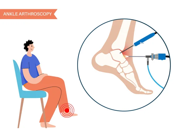 Ankle Arthroscopy Procedure Feet Joint Minimally Invasive Surgery Concept Arthroscope — Stock Vector