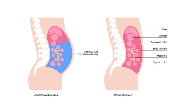 Anatomía Ascitis Fluido Cavidad Peritoneal Distensión Abdominal Dolor Hinchazón Náuseas — Vector de stock