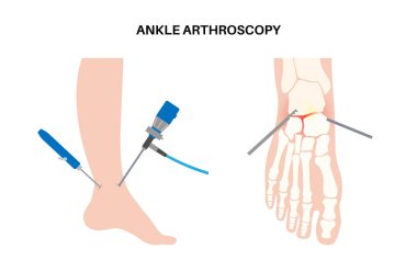 Ayak bileği artroskopisi prosedürü. Ayak eklemi minimum invaziv cerrahi konsepti. Artroskop ve artroskopik alet. Ayak tedavisi, bacak ağrısı ve iltihap. Anatomik x ışını vektör çizimi