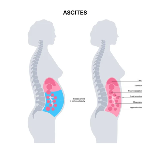 Anatomía Ascitis Fluido Cavidad Peritoneal Distensión Abdominal Dolor Hinchazón Náuseas — Archivo Imágenes Vectoriales