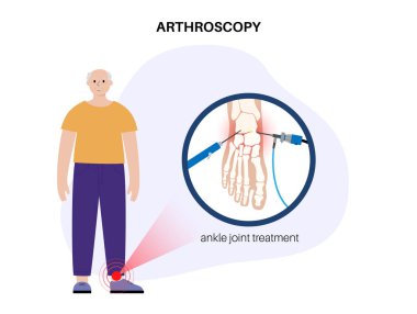 Ayak bileği artroskopisi prosedürü. Ayak eklemi, minimal invaziv ameliyat, klinikte yaşlı bir adam. Artroskop ve artroskopik alet. Ayak tedavisi, bacak ağrısı ve iltihaplanma düz vektör çizimi