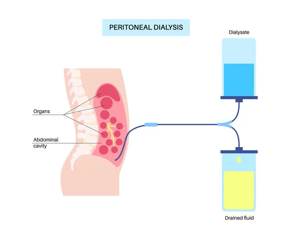 Peritoneální Dialýza Tekutina Peritoneální Dutině Peritoneum Břiše Látky Jsou Vyměňovány — Stockový vektor