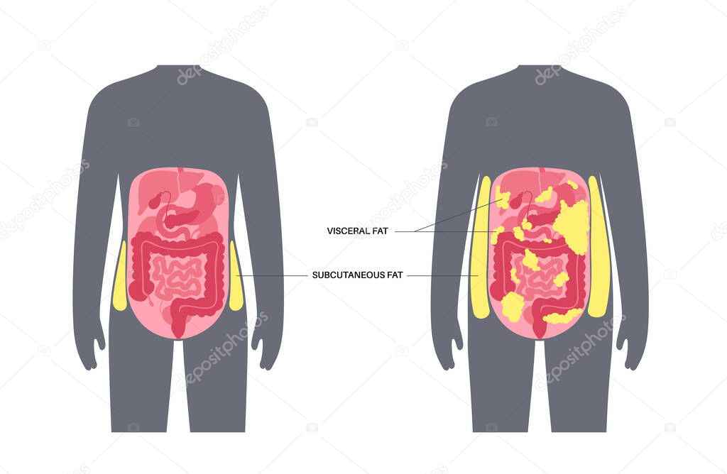 Cartel Médico Grasa Visceral Grasa Del Vientre Rodea Los Órganos