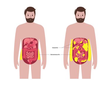 İçsel şişman tıbbi afişi. Göbek yağı karın boşluğundaki iç organları sarar. Aşırı kilolu hastalık konsepti. Kilo vermek, yağ aldırmak ve diyet yapmak. Obezite insan silueti düz vektör çizimi