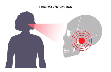 Temporomandibular joint disorder. TMD or TMJ dysfunction. Pain in the jaw joint, temporal bone locking or displaced disc. Transcutaneous electrical nerve stimulation. Human skull and mandible vector clipart