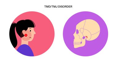 Temporomandibular joint disorder. TMD or TMJ dysfunction. Pain in the jaw joint, temporal bone locking or displaced disc. Transcutaneous electrical nerve stimulation. Human skull and mandible vector clipart