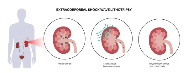 Njursten Behandling Extrakorporeal Chockvåg Litotripsi Icke Invasivt Alternativ Till Operation — Stock vektor