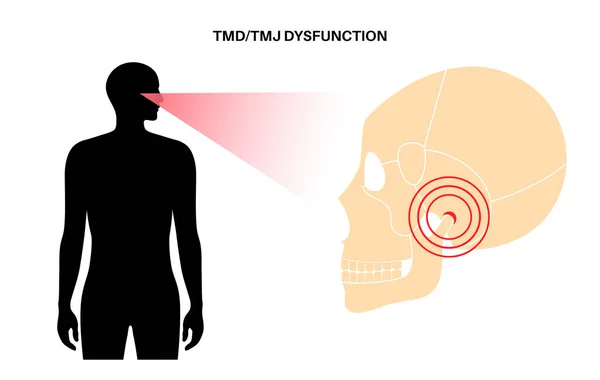 Distúrbio Articulação Temporomandibular Dtm Disfunção Atm Dor Articulação Mandíbula Bloqueio — Vetor de Stock