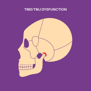 Temporomandibular eklem bozukluğu. TMD ya da TMJ bozukluğu. Çene ekleminde ağrı, şakak kemiği kilitlenmesi ya da yerinden çıkmış disk. Transkütan elektriksel sinir uyarılması. İnsan kafatası ve çene vektörü