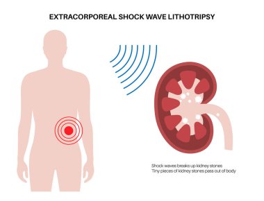 Kidney stones treatment. Extracorporeal shock wave lithotripsy. Non invasive alternative to surgery procedure. ESWL concept. Sand like fragments pass out of the body in urine flat vector illustration clipart