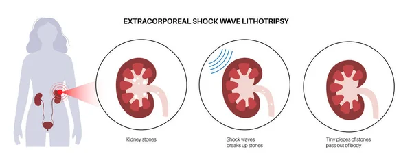 Tratamiento Cálculos Renales Litotricia Extracorpórea Por Ondas Choque Alternativa Invasiva — Vector de stock