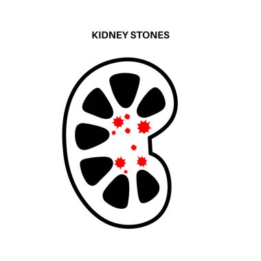Böbrek taşı tedavisi. Extracorporeal şok dalgası litotripsi. Ameliyata karşı zararsız bir alternatif. ESWL konsepti. İdrarda vücuttan çıkan kum gibi düz bir vektör çizimi.