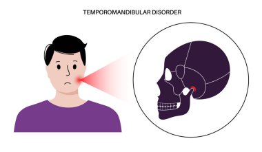 Temporomandibular eklem bozukluğu. TMD ya da TMJ bozukluğu. Çene ekleminde ağrı, şakak kemiği kilitlenmesi ya da yerinden çıkmış disk. Transkütan elektriksel sinir uyarılması. İnsan kafatası ve çene vektörü