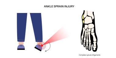 Bileğimi burktum. Çarpık ayaklar, acı ve şişlik. Göz yaşları, esneme ya da bağlarda yırtılma. Klinikte ayak travması anatomik poster, teşhis ve tedavi. Bacak problemi, X ışını vektör çizimi