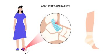 Bileğimi burktum. Çarpık ayaklar, acı ve şişlik. Göz yaşları, esneme ya da bağlarda yırtılma. Klinikte ayak travması anatomik poster, teşhis ve tedavi. Bacak problemi, X ışını vektör çizimi