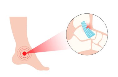 Bileğimi burktum. Çarpık ayaklar, acı ve şişlik. Göz yaşları, esneme ya da bağlarda yırtılma. Klinikte ayak travması anatomik poster, teşhis ve tedavi. Bacak problemi, X ışını vektör çizimi