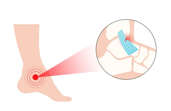 足首の損傷を捻挫 足のねじれ 痛みや腫れ 靭帯の伸張または破裂 足の外傷解剖学的ポスター 診断とクリニックでの治療 脚の問題 X線ベクトル図 — ストックベクタ