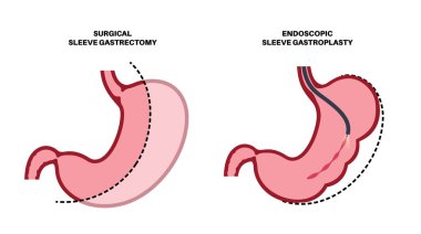 Endoskopik kollu gastroplasti ve gastrektomi ameliyatı. Mide ameliyatı, kilo kaybı mide ameliyatı. Laparoskopi konsepti. İnsan vücudu düz vektör medikal illüstrasyonunda aşırı kilolu problem