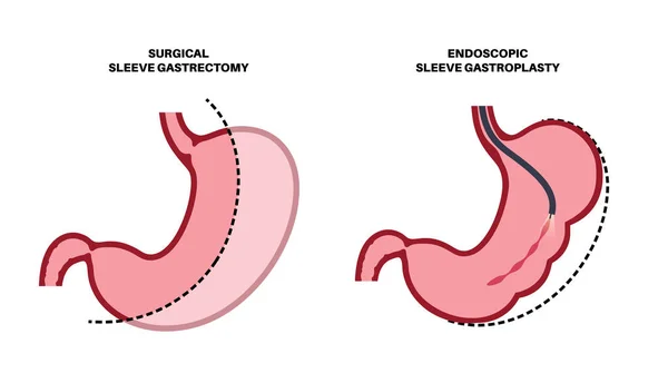 Cirugía Gastroplastia Gastrectomía Manga Endoscópica Cirugía Estomacal Pérdida Peso Procedimiento — Archivo Imágenes Vectoriales