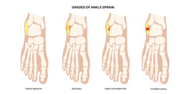 Bilek burkulması. Çarpık ayaklar, acı ve şişlik. Göz yaşları, esneme ya da bağlarda yırtılma. Klinikte ayak travması anatomik poster, teşhis ve tedavi. Bacak yaralanması, X ışını vektör çizimi