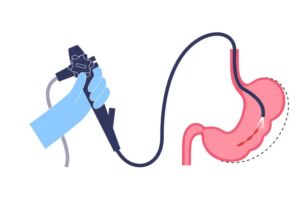 Endoskopowa Gastroplastyka Rękawów Operacja Żołądka Utrata Masy Ciała Zabieg Żołądkowy — Wektor stockowy