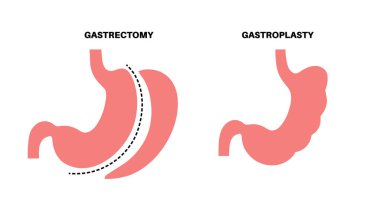 Endoskopik kollu gastroplasti ve gastrektomi ameliyatı. Mide ameliyatı, kilo kaybı mide ameliyatı. Laparoskopi konsepti. İnsan vücudu düz vektör medikal illüstrasyonunda aşırı kilolu problem