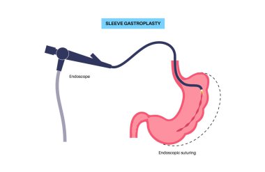 Endoskopik kollu gastroplasti. Mide ameliyatı, kilo kaybı mide ameliyatı. Laparoskopi konsepti. İnsan vücudunda aşırı kilo problemi. Ameliyattan sonra iç organ. Düz vektör tıbbi illüstrasyon