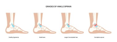 Bilek burkulması. Çarpık ayaklar, acı ve şişlik. Göz yaşları, esneme ya da bağlarda yırtılma. Klinikte ayak travması anatomik poster, teşhis ve tedavi. Bacak yaralanması, X ışını vektör çizimi