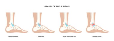 Sprained ankle grades. Twisted feet, pain and swelling. Tears, stretch or rupture of ligaments. Foot trauma anatomical poster, diagnosis and treatment in clinic. Leg injury, X ray vector illustration clipart